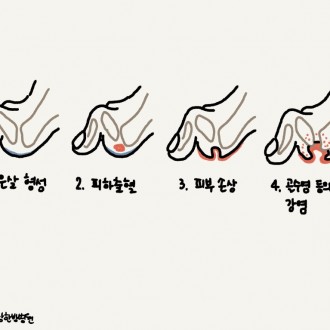 당뇨발괴사
