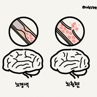 뇌출혈 후유증