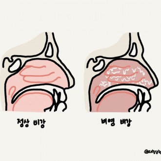 비염