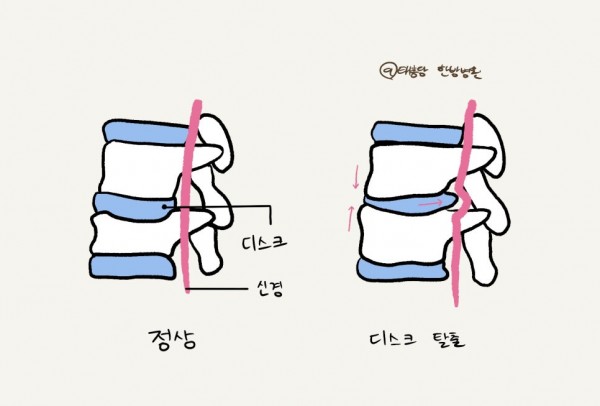 허리디스크