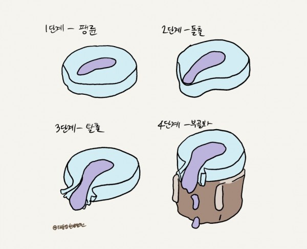 허리디스크