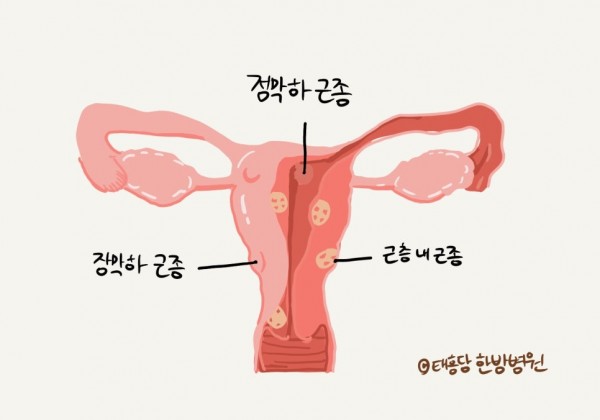 자궁근종 수술 후 회복