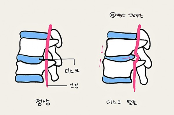 목디스크