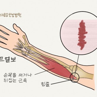  팔꿈치통증 골프엘보