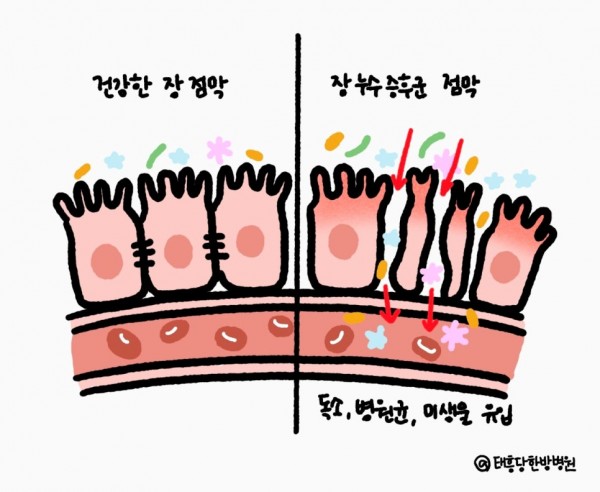 지루성 피부염