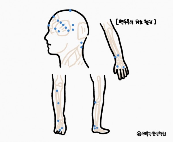 편두통