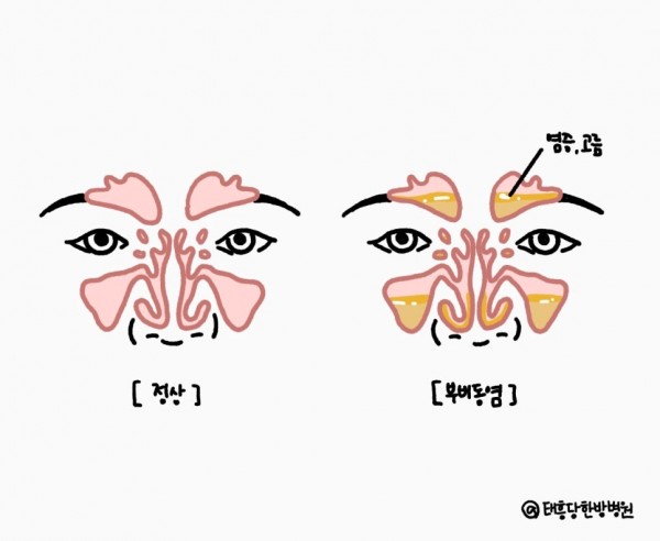 부비동염