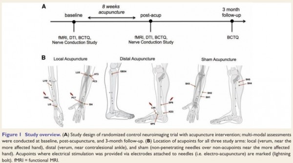 하버드 대학교 및 국내 연구진 공동 연구, 손목터널증후군(Carpal Tunnel Syndrome, CTS)과 침치료