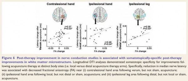 하버드 대학교 및 국내 연구진 공동 연구, 손목터널증후군(Carpal Tunnel Syndrome, CTS)과 침치료