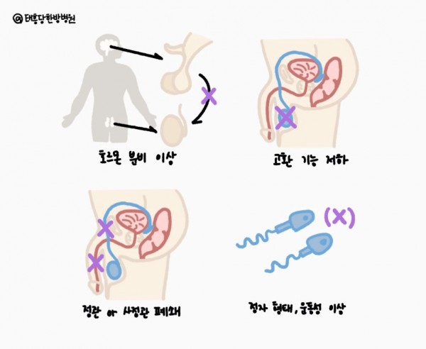 남성 난임 원인